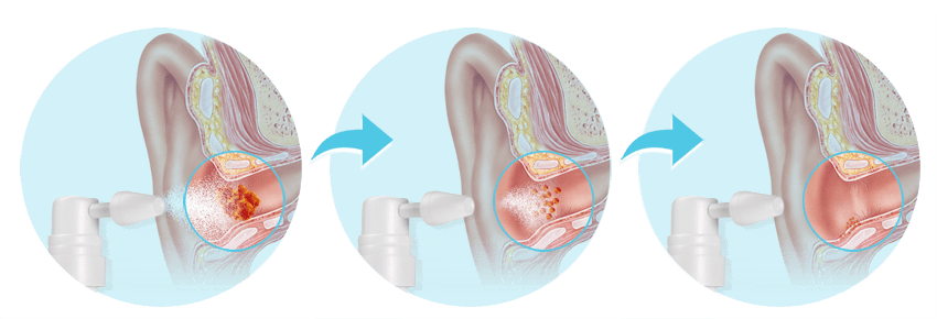 Earwax removal mechanism and effectiveness